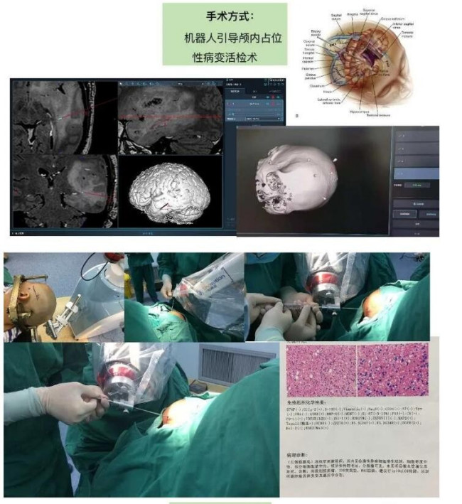 重庆三博江陵病院能够做脑袋里面肿瘤的活检？不是开刀，是微创的
z1.jpg